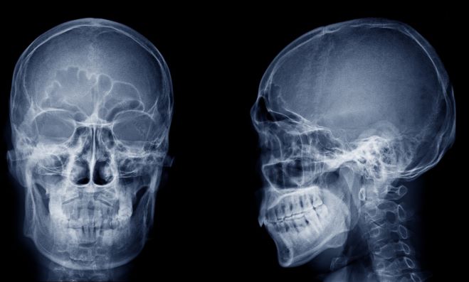 AO CMF NA Module Series 3—Skull & Frontal Sinus