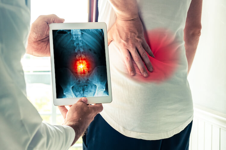 The Hidden Cost Of Delaying Back Surgery