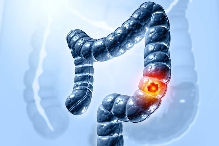 Don’t Overlook Processed Meat As Colorectal Cancer Risk Factor